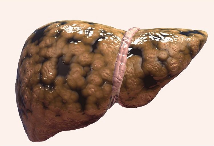 脂肪肝脂肪肝是指肝细胞内脂肪堆积过多引起的病变