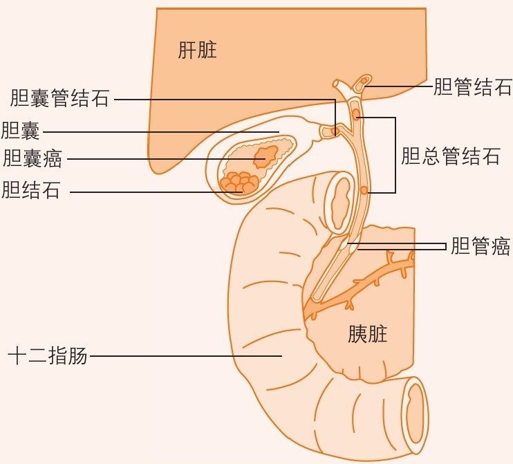 胆囊的疾病