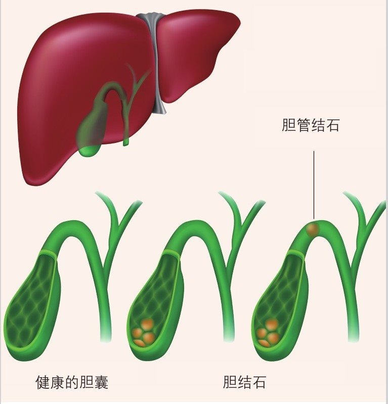 胆结石示意图