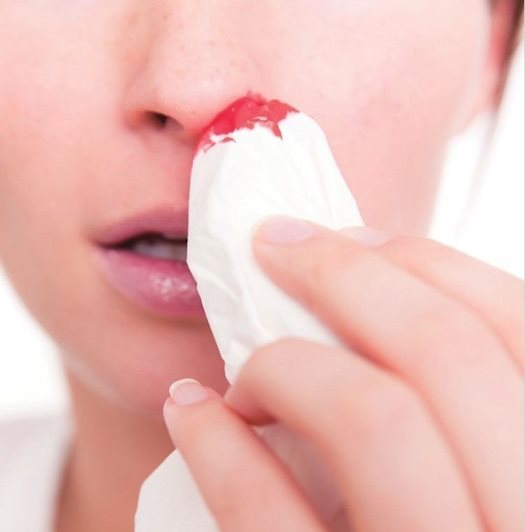 鼻出血是常见的症状，患者不必惊慌，可冷静应对