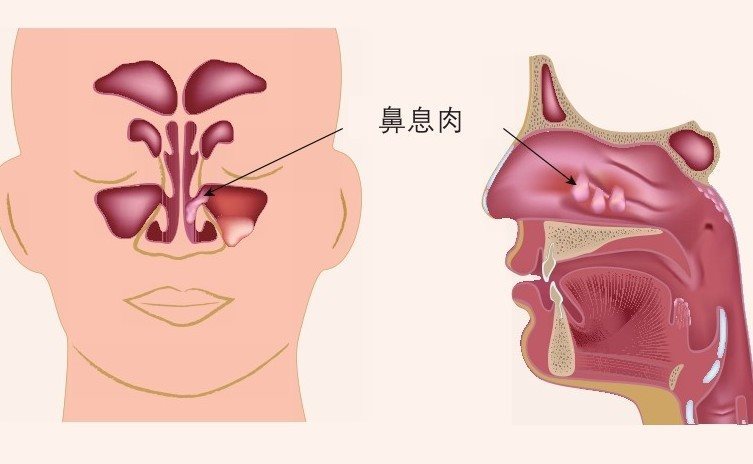 鼻息肉在鼻腔中的位置图