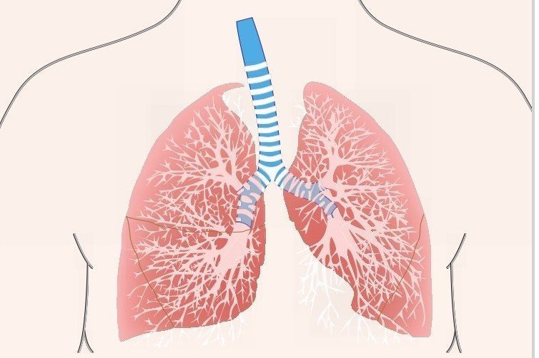 肺炎示意图 肺炎是由多种病原体引起的炎症，临床表现为发热、持久干咳、呼吸急促等