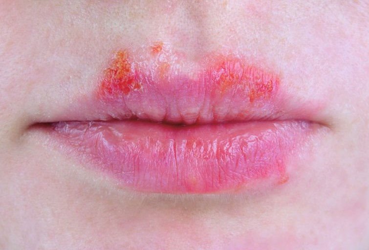 嘴唇皴裂是指口唇出现裂隙或裂沟，是缺乏维生素B2 及阴虚火旺的症状