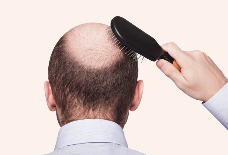 全世界约有一半的成年男性都受到脱发的困扰