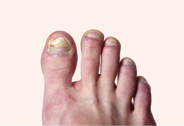 灰趾甲是由浅部霉菌感染所引起的甲板病变，多由手足癣传播所致，会导致甲板出现高低不平、增厚、变色、变形的现象