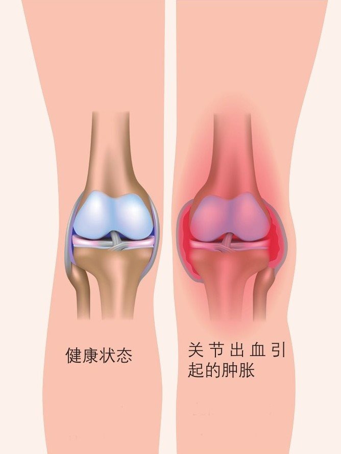 剧烈运动中扭伤关节会导致关节肿胀
