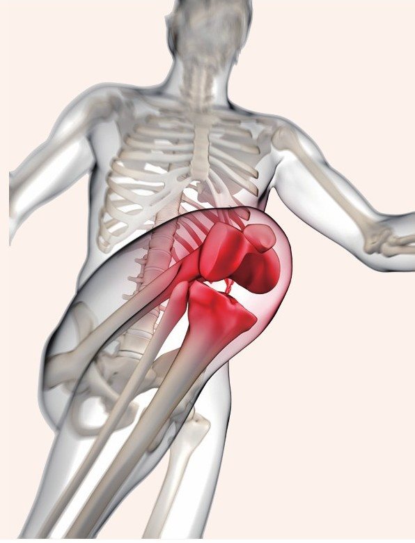 膝关节疼痛并伴有严重的水肿，可能是膝盖受到撞击或扭伤导致滑膜炎，使膝盖附近的组织充血引起的