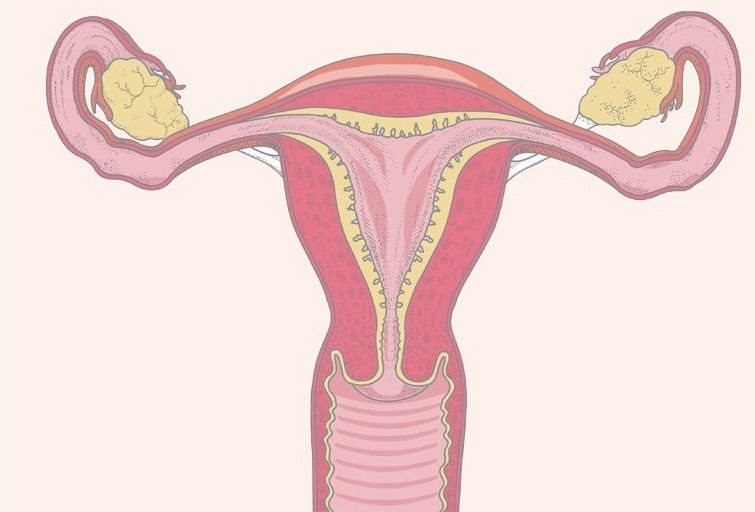 子宫发育不全、子宫屈曲及颈管狭窄是造成原发性痛经的重要原因