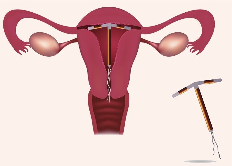 使用了宫内节育器的女性发生痛经，其原因可能是节育器刺激内膜，导致子宫肌肉收缩过强所致