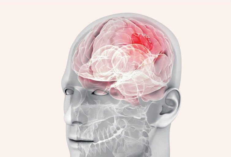 脑肿瘤是神经系统常见疾病之一，对人体神经系统的功能有很大的危害