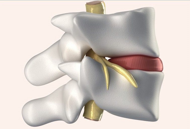 椎间盘髓核示意图椎间盘髓核是连接上下椎骨的弹性纤维中间的一粒黄豆大小的果胶状物质