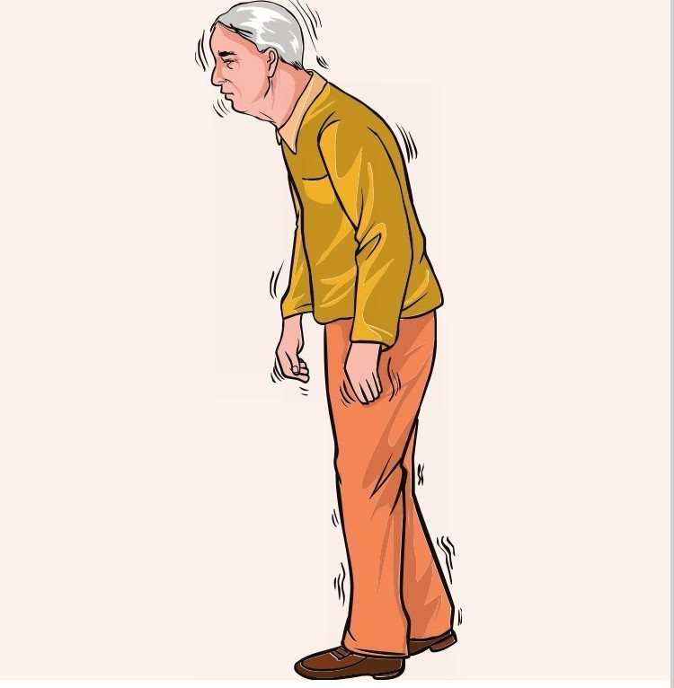 帕金森病是一种常见于中老年人的神经系统变性疾病，主要表现为患者动作缓慢，手脚或身体的其他部分震颤，身体僵硬等