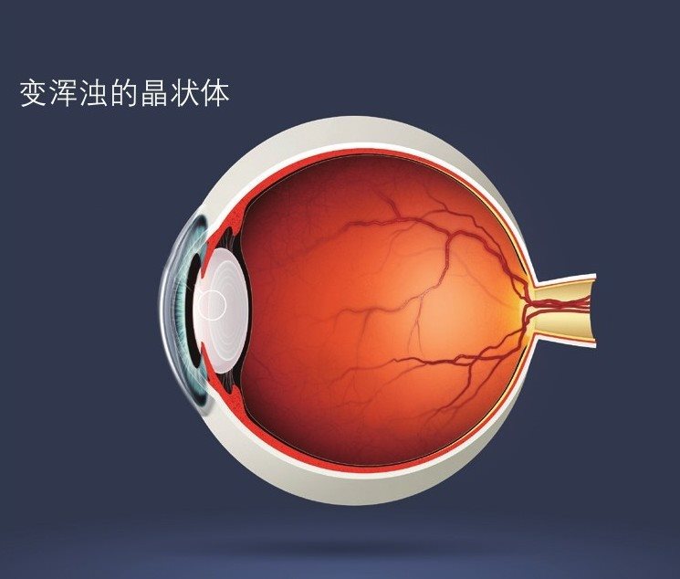 白内障是由于眼内的晶状体变性引起的，晶状体由透明变浑浊，这样就会引发白内障
