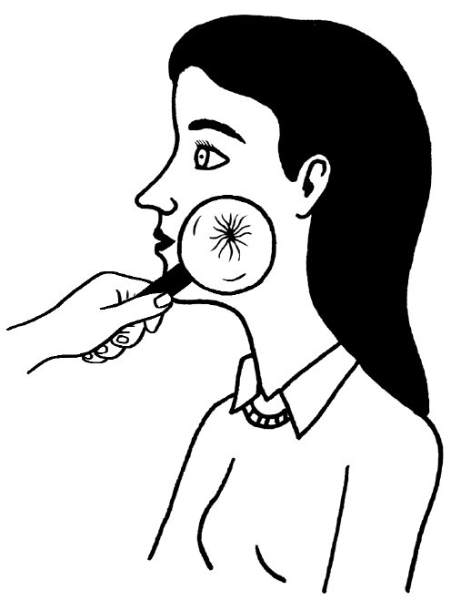 血管瘤、蜘蛛痣和扩张的毛细血管