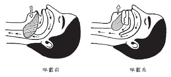 佩戴口腔矫治器对睡眠呼吸暂停综合征病人舌根后坠的改善