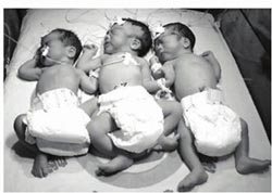 三胞胎试管婴儿