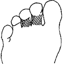 眼部不适的治疗