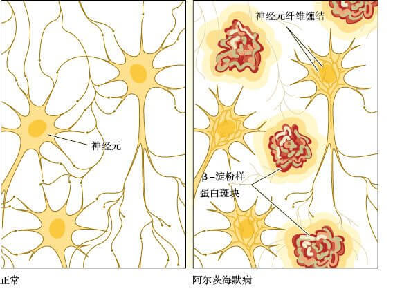  阿尔茨海默病的神经元纤维缠结和β-淀粉样蛋白斑块