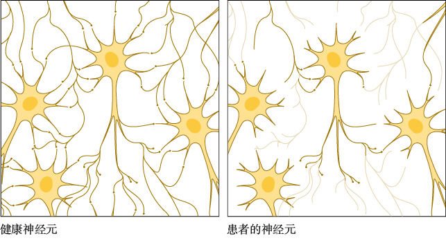  阿尔茨海默病的细胞损伤