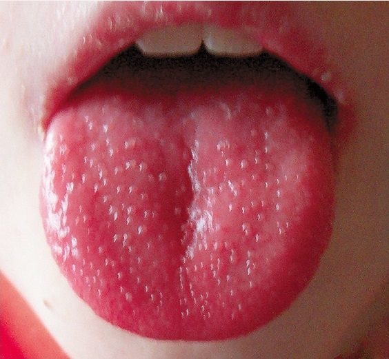 第三章 看舌象主要看舌质和舌苔