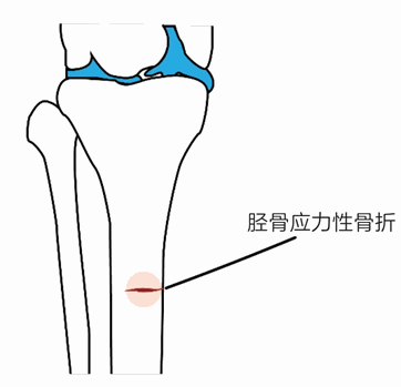 第二十四章 跑步至应力性骨折,需要躺100天吗?