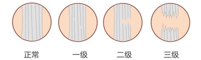 第二十二章 有关韧带损伤康复,我们应当知道的