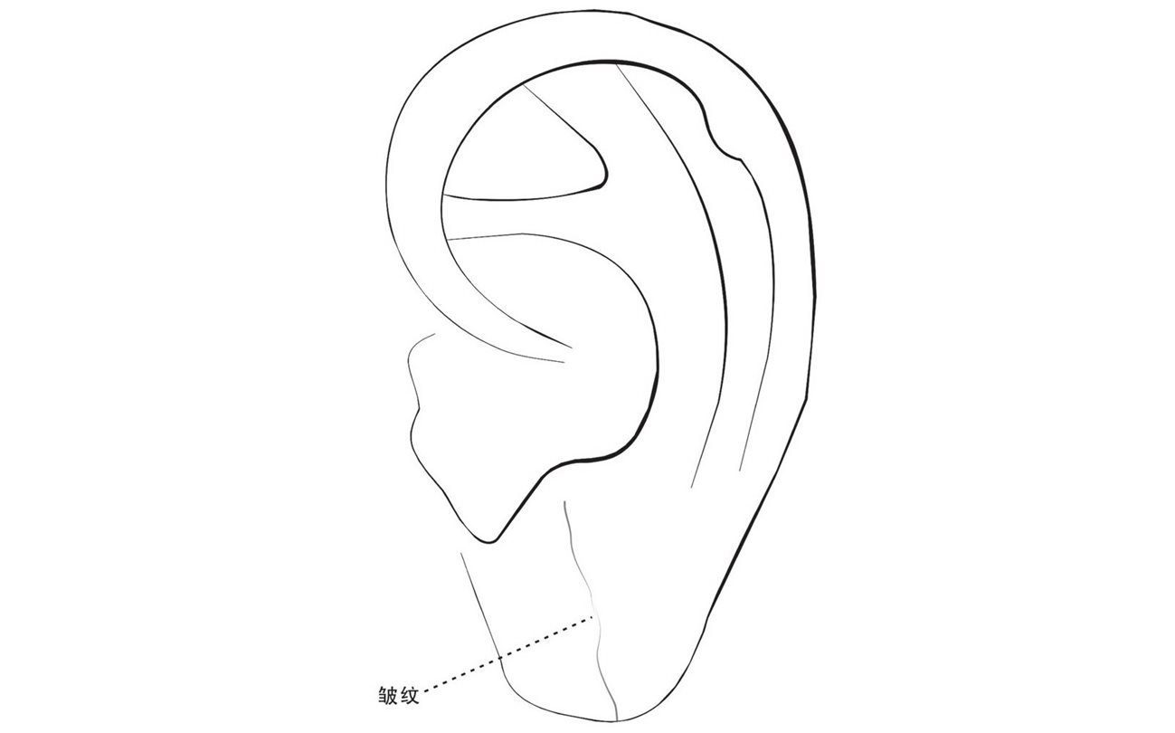 耳垂皱纹