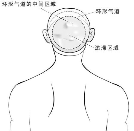 观察到的耳垂与后脑的环形气道及瘀滞