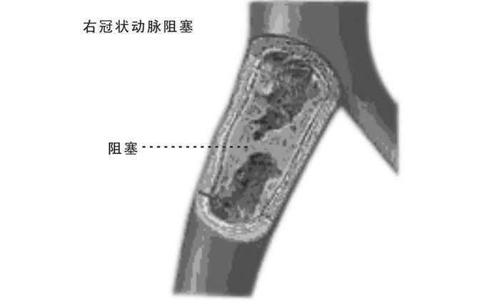右冠状动脉阻塞和供血不足