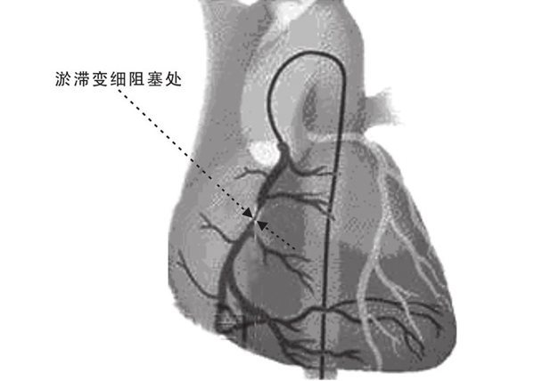 显影剂注入冠状动脉观察到的情况