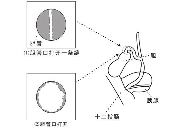 强行打开胆管门户