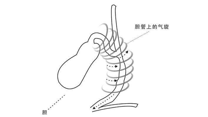 胆管强烈气旋