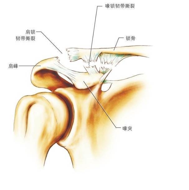 肩锁关节损伤