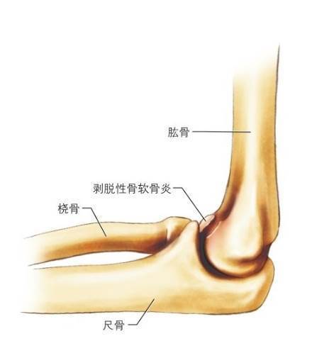 剥脱性骨软骨炎