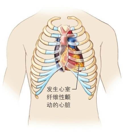 心震荡