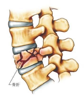 腰椎爆裂性骨折