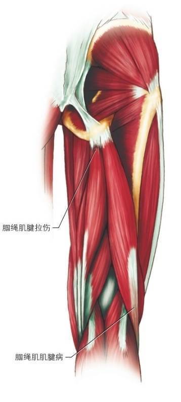 腘绳肌腱拉伤