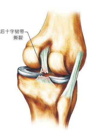 后十字韧带撕裂