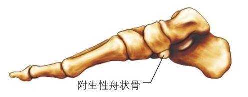 疼痛的附生性舟状骨